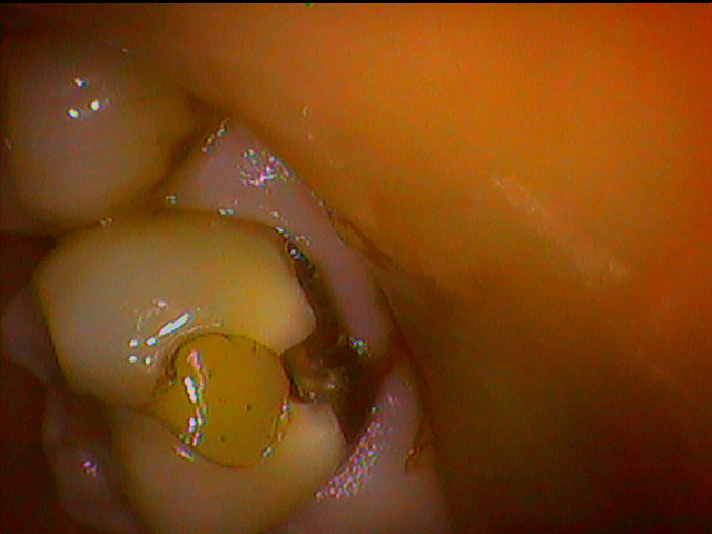 奥歯の気づきにくい虫歯 船橋 歯医者 ベリーデンタルクリニック 土日も診察